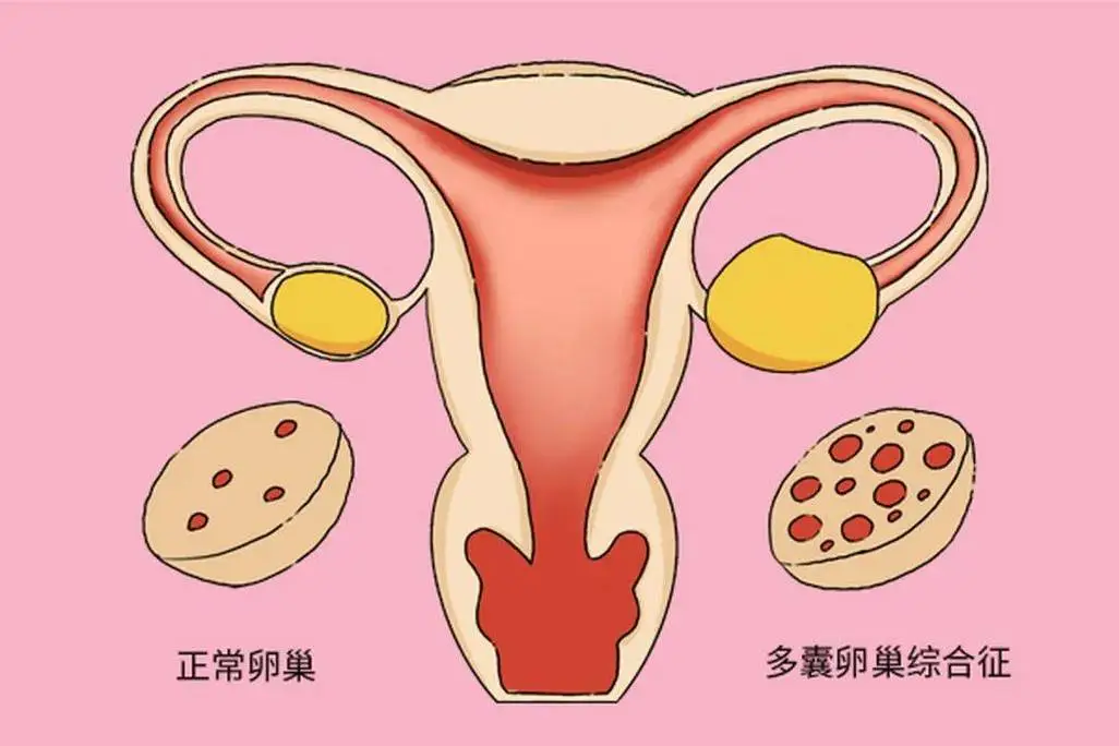多囊卵巢综合征