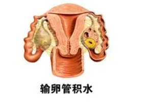  输卵管积水